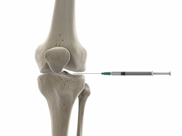 injektion i knäleden för artros