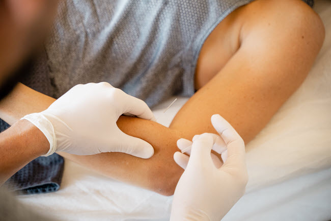 dry-needling för tennisarmbåge