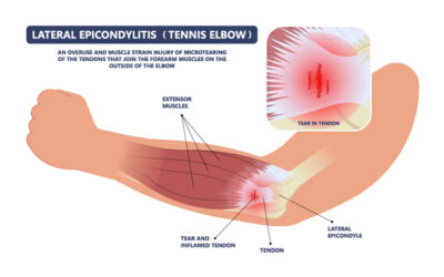 Är PRP bättre än kortison vid tennisarmbåge?