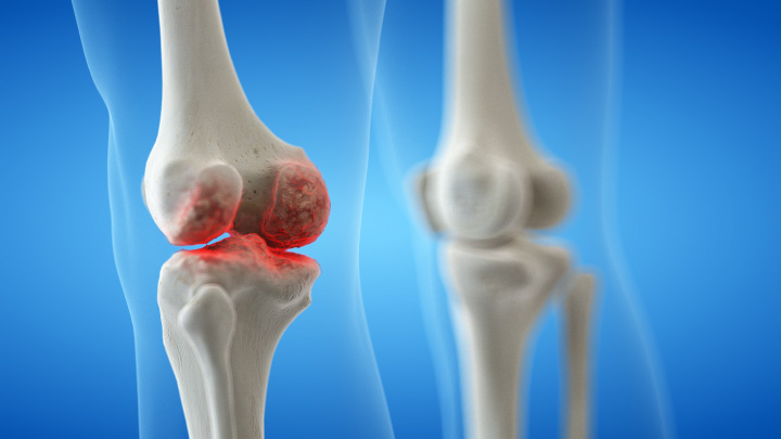 smärtsam knäled som kan behandlas med PRP eller hyaluronsyra