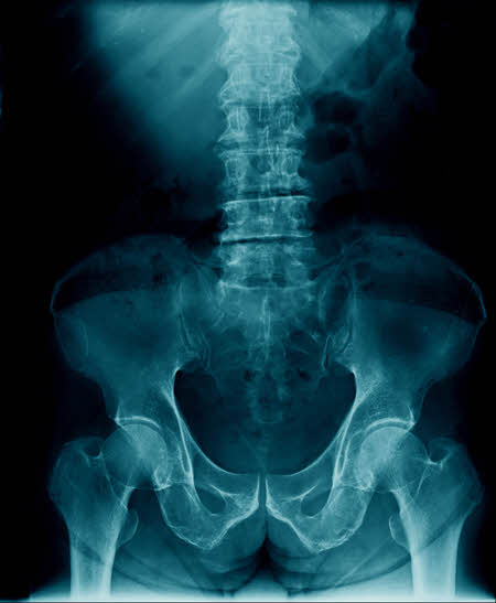 röntgenbild ländrygg och bäcken och höftled